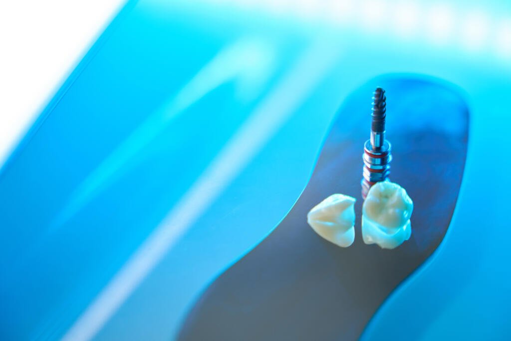 root canal in Katy TX