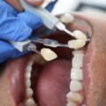 Dental Crowns in Katy, TX: Protection, Restoration & Natural-Looking Results
