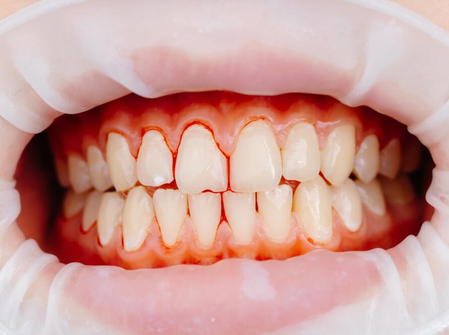 Teeth Whitening for Sensitive Teeth in Katy