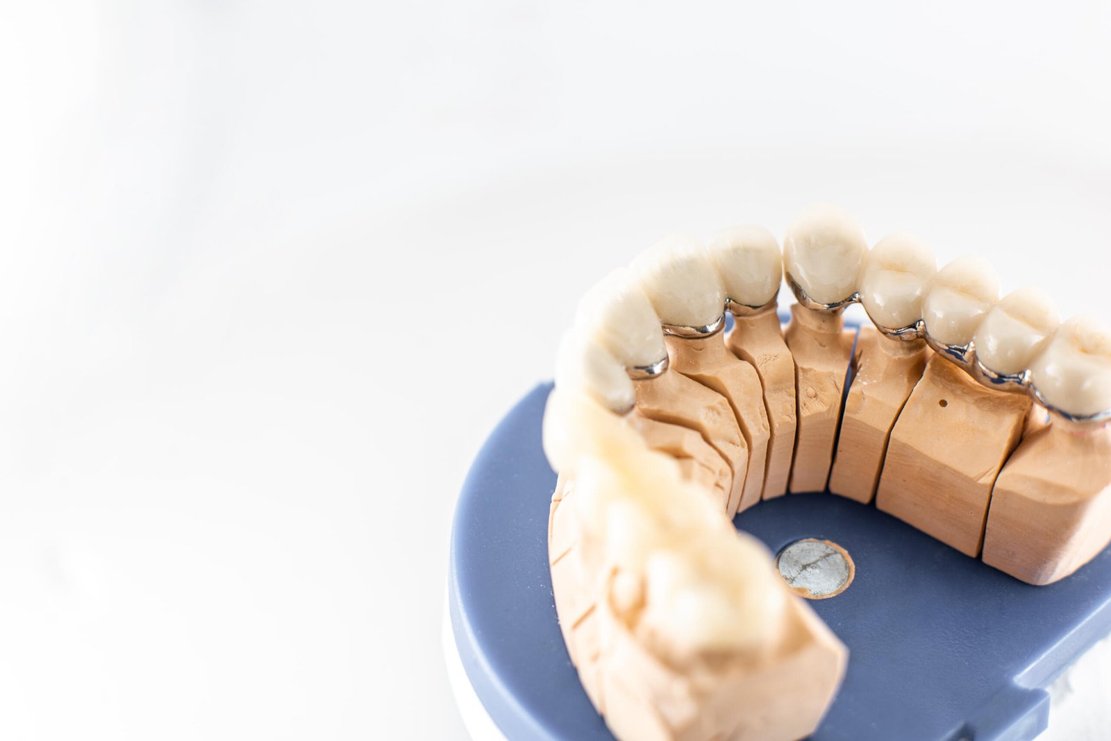 dental bridges Katy TX